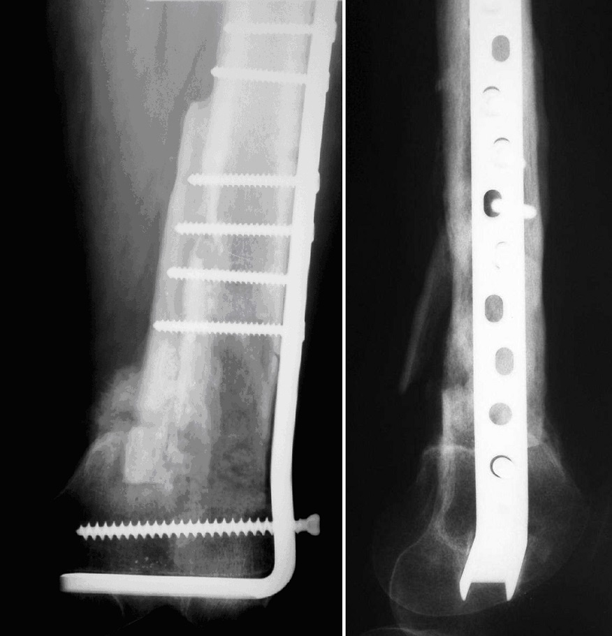 Controllo a 3 mesi di distanza dopo osteosintesi con lama placca, innesto osseo contrapposto, cellule staminali autologhe e gel piastrinico