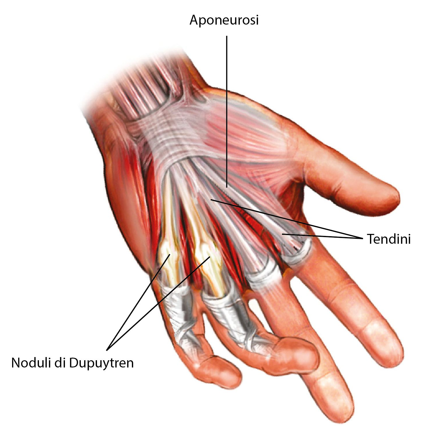 Fig. 1. Anatomia patologica macroscopica del morbo di Dupuytren