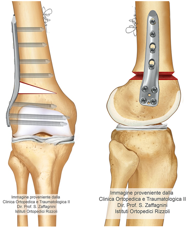 osteotomia femorale mediale in chiusura