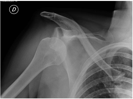 Esame radiografico di lussazione gleno-omerale anteroinferiore.