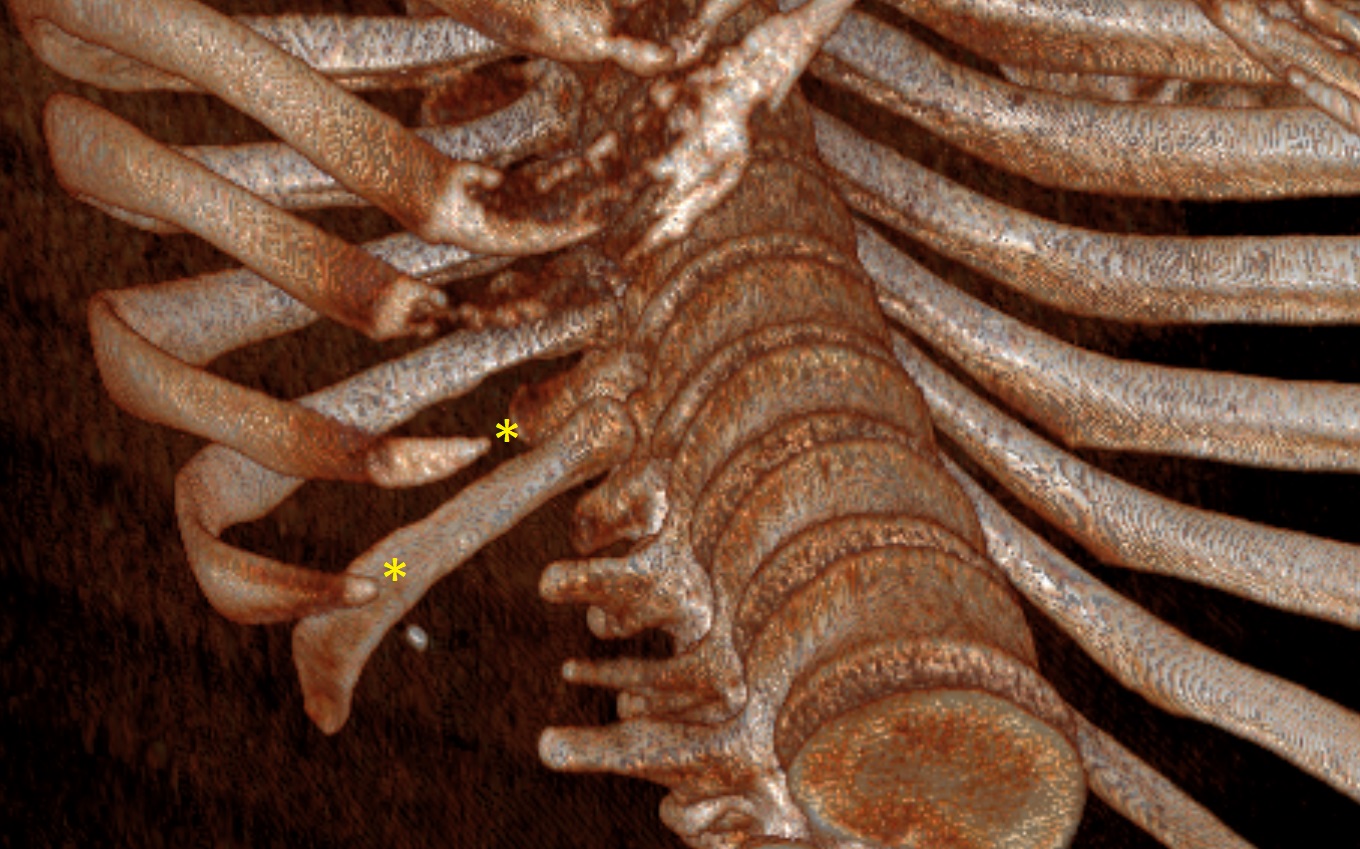 Ricostruzione Tc Torace 3D che mostra le punte costali libere della X-XI costa 