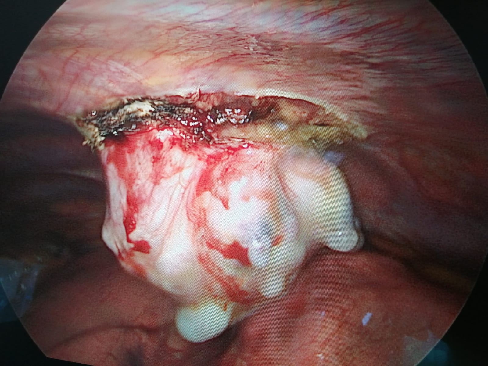 Esostosi costale endotoracica trattata in Videotoracoscopia (VATS)