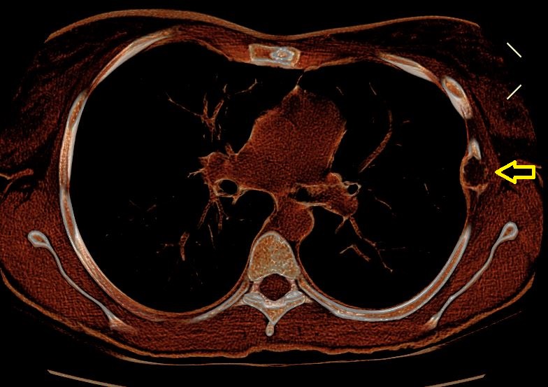 TAC Torace che mostra una displasia fibrosa a carico della VI costa di sinistra