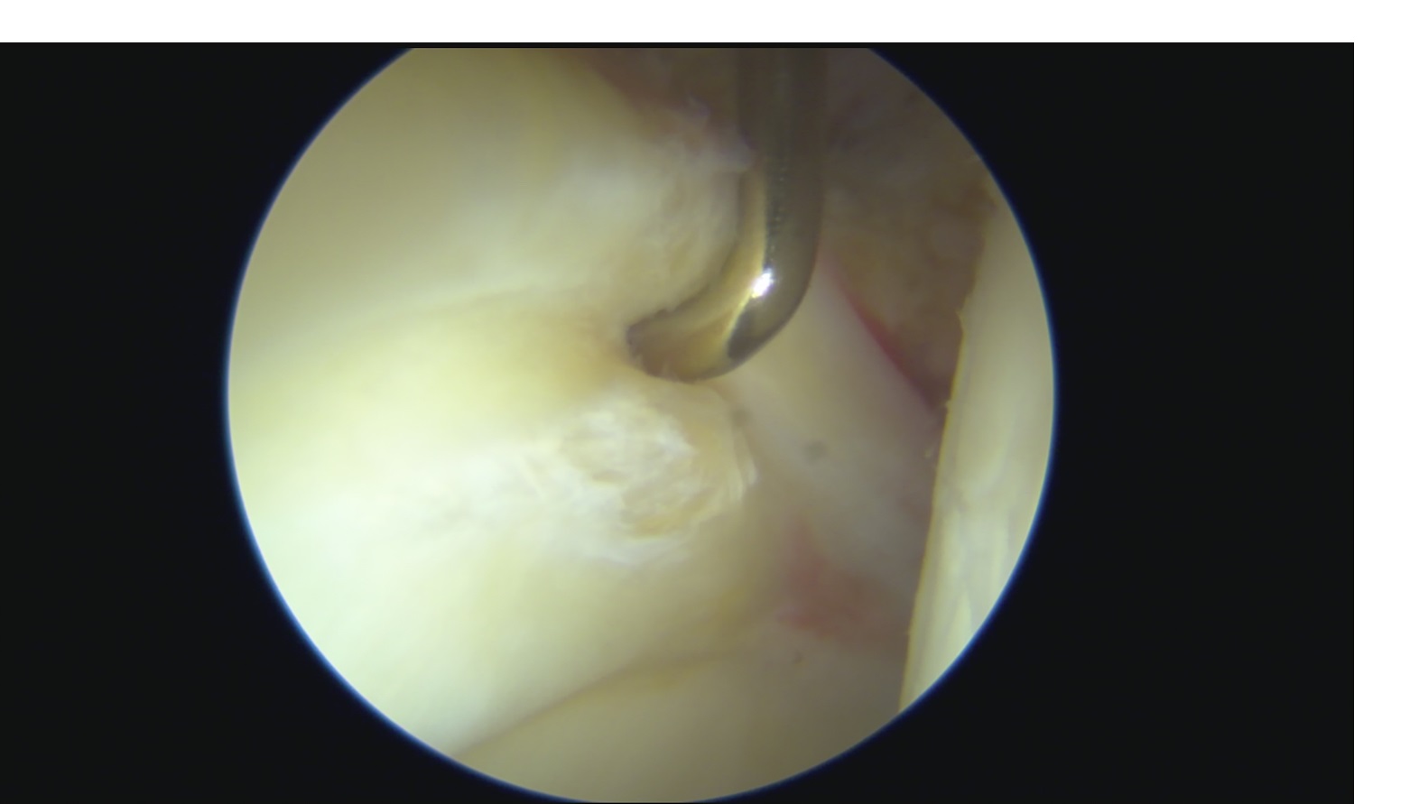 labbro acetabolare