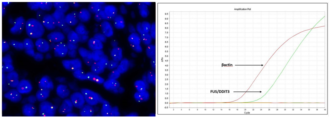 Tracciato elettroforetico in un caso di sarcoma di Ewing e plot di amplificazione in un caso di liposarcoma mixoide