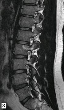 Figura 3 - Il controllo con RM, eseguito dopo 15 mesi dalla procedura, non fa più apprezzare l'osteoma osteoide; le strutture foraminali sono indenni; sono ancora presenti modesti fenomeni riparativi nella sede della termoablazione.