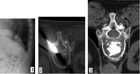 Immagini relative alla vertebroplastica