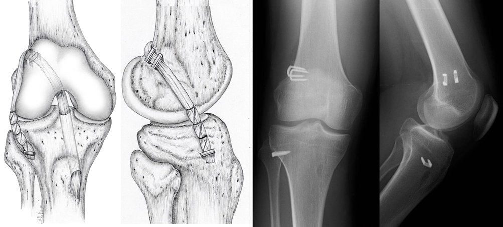 Tecnica ricostruzione e controllo radiografico dopo l’intervento chirurgico.