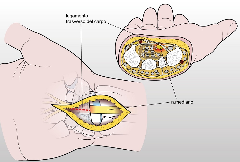 Fig. 1. Sezione anatomica del canale del carpo