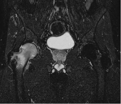 Fig 2 Edema transitorio della testa del femore destra alla risonanza magnetica (sequenza T2-weighted)