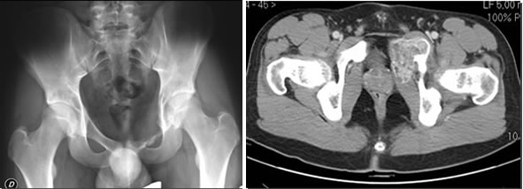 Figg. 10-11 - Immagini radiografiche e TC prima dell’embolizzazione dove è apprezzabile la lesione focale osteolitica della branca ileo-pubica sinistra