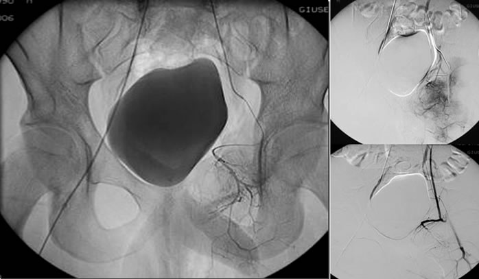 Figg. 3-5 - Immagini angiografiche della prima embolizzazione