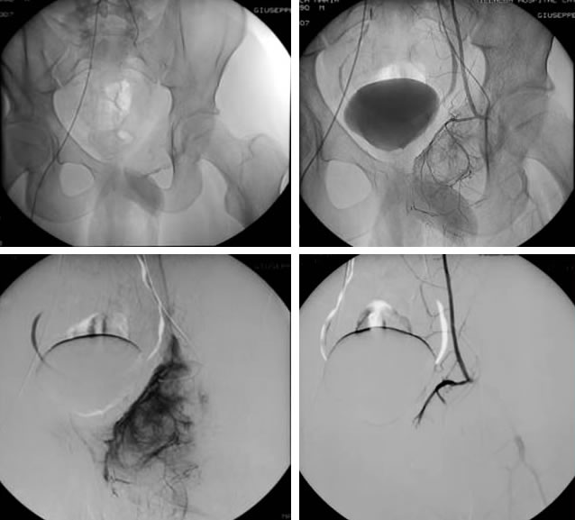 Figg. 6-9 - Immagini angiografiche della seconda embolizzazione