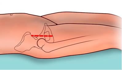 Fig. 1 - Incisione cutanea per via d’accesso anteriore