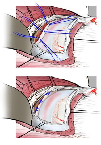 Fig. 2c - Reinserzione del labrum acetabolare con ancorette