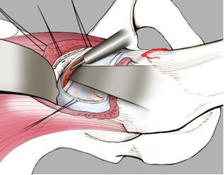 Fig. 2b - Rimodellamento osseo della porzione acetabolare “in eccesso”