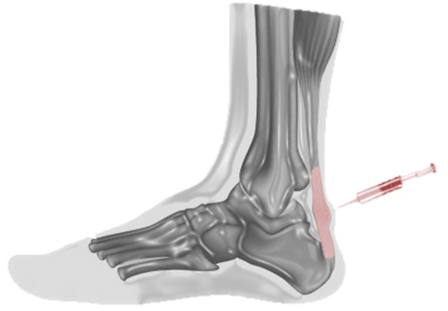 Immagine di repertorio: infiltrazione di PRP per il trattamento della tendinopatia d'Achille