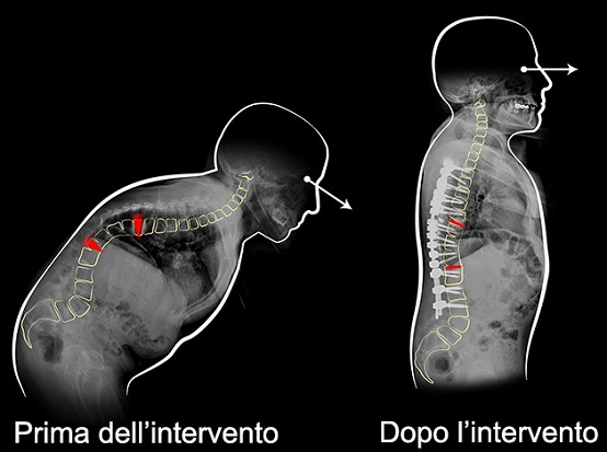 Radiografia prima e dopo l'intervento