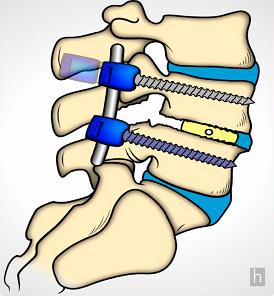 Vertebre stabilizzate nel trattamento del rachide degenerativo