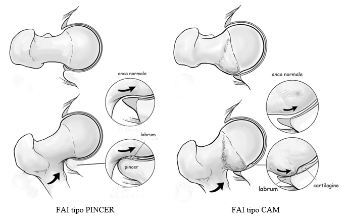 Fig 3.: FAI tipo PINCER e tipo CAM: in rosso è evidenziata la zona articolare rispettivamente interessata