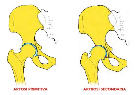 Artrosi primaria e secondaria