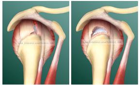 Figg. 2-3: Lesione a L del sovraspinoso e lesione “crescent” del sovraspinoso