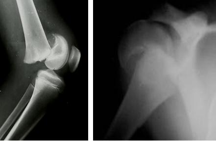 Fig. 1a-b: esempi di distacco epifisario puro tipo Salter I dell'omero prossimale (a) e del femore distale (b)