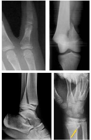 Fig. 2a-b-c-d: esempi di distacco epifisario tipo Salter II : base della falange prossimale del 5° dito (a), femore distale (b), tibia distale (c), radio distale (d)