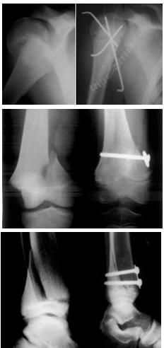 Fig. 3a-b-c: esempi di osteosintesi a minima di distacco epifisario: omero prossimale con fili di Kirschner (a), femore distale con vite inteframmentaria (b), tibia distale con duplice vite interframmentaria (c)