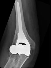 Fig.4 - Emiartroprotesi omerale