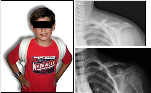 Fig. 1a-b-c: salvo rare eccezioni le fratture del terzo medio di calvicola nell'età pediatrica (sopra) vengono trattate conservativamente con bendaggio “a otto”. Controllo radiografico a distanza con valida callificazione (sotto) 