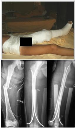 Fig. 10a-b: frattura diafisaria di femore trattata tramite gesso plevipodalico inglobante filo di trazione sovracondilico (a). Frattura diafisaria di femore scomposta trattata con successo tramite osteosintesi retrograda a cielo chiuso con chiodi endomidollari (b).