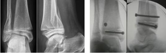 Fig. 11a-b: frattura del perone distale e distacco epifisario misto della tibia (a). Intervento di osteosintesi del distacco epifisario con doppia vite interframmentaria. La frattura peroneale è stata trattata incruentemente (b) 