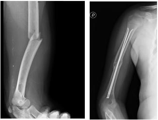 Fig. 3a-b: esempio di osteosintesi di frattura diafisaria dell'omero (a) tramite inchiodamento endomidollare con chiodi di Nancy retrogradi (b)