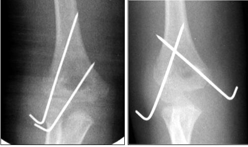 Fig. 6a-b: esempio di osteosintesi di frattura sovracondiloidea dell'omero distale tramite pinning percutaneo: configurazione laterale con fili divegenti (a), configurazione a fili incrociati (b)