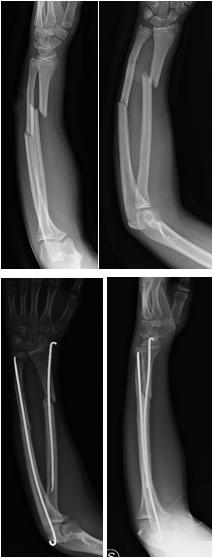 Fig. 9a-b: esempio di frattura biossea scomposta di  avambraccio (a). Osteosintesi realizzata tramite inchiodamento endomidollare retrogrado con fili di Kirschner (b)