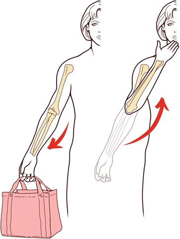 Fig. 5 - Il fenomeno del Carrying angle, per cui il gomito risulta così valgo in estensione e varo in flessione. Nel gomito rigido dopo fratture questo fenomeno può scomparire