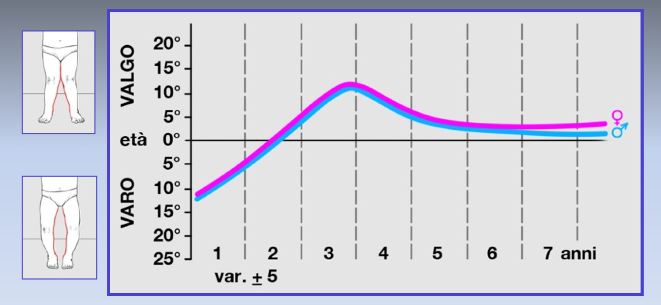 FIG.1: fisiologico sviluppo assiale del ginocchio nei primi 7 anni di vita.