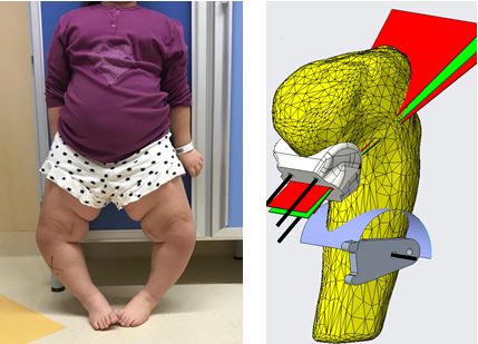 FIG.5 (a-b): grave ginocchio varo bilaterale in m. di Blount; planning radiografico.