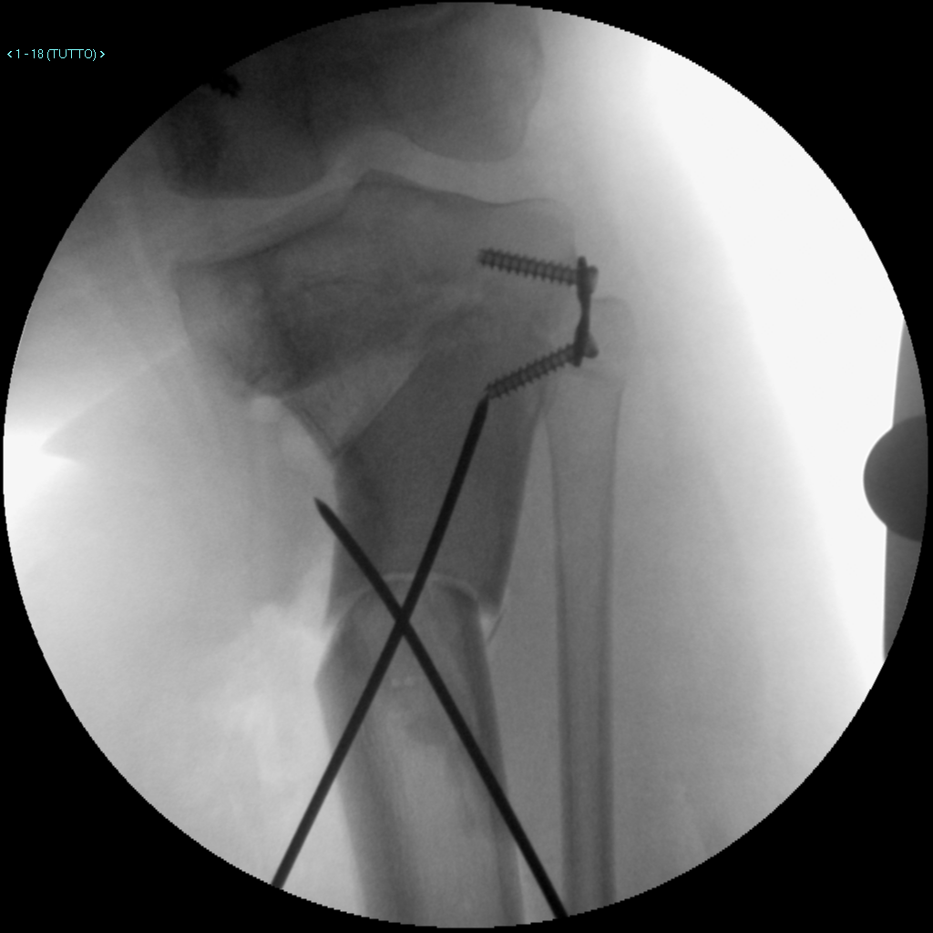 FIG.5 (d): correzione della deviazione assiale tramite doppia osteotomia tibiale prossimale ed epifisiodesi asimmetrica tibiale laterale.