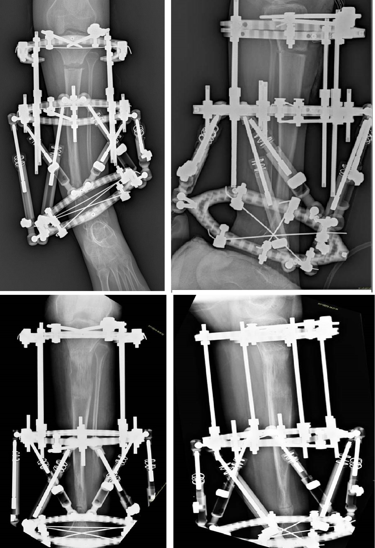 Fig.3-4-5-6: rx AP e LL – trattamento tramite fissatore esterno esapodalico – correzione della dismetria e del difetto assiale sui 2 piani.