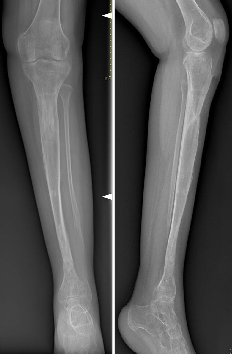 Fig. 7-8: rx AP e LL – Follow-up ad 1 anno dalla rimozione del fissatore esterno