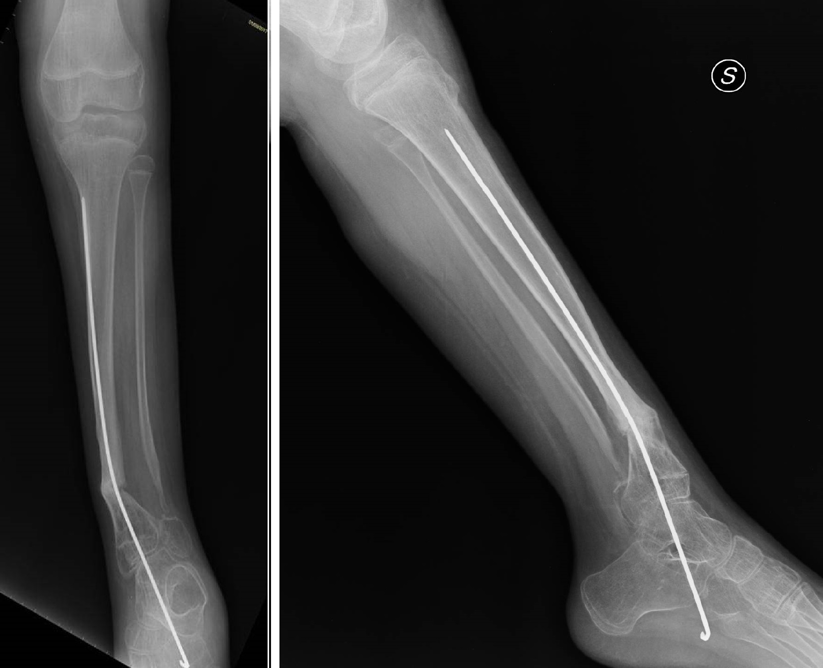 Fig.1-2: rx AP e LL – Pseudoartrosi congenita di tibia, incompleta consolidazione al terzo distale tibiale e peroneale con deviazione assiale in valgo e procurvazione