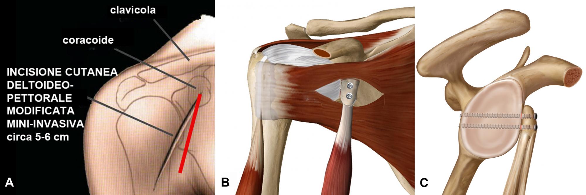 Fig. 4 - Capsuloplastica (stabilizzazione della spalla) artrotomica (a cielo aperto) secondo Latarjet: A, accesso artrotomico (a “cielo-aperto”) modificato mini-invasivo (in rosso); B e C, riparazione della lesione capsulare mediante trasposizione del tendine congiunto con “bratta ossea” di coracoide (per colmare difetto osseo della glena, presente in seguito a numerose lussazioni recidivanti) fissata con 2 viti metalliche