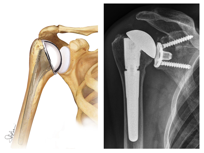 Fig. 7 - Sostituzione totale di spalla