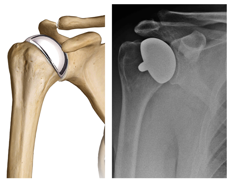 Fig. 8 - Emiartroplastica di rivestimento 