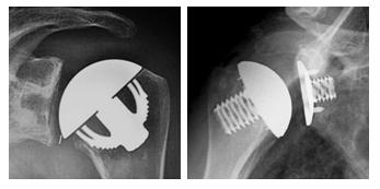 Figg. 12-13: Protesi emicefalica con componente glenoidea in polietilene (radiotrasparente) e con componente glenoidea in metallo (metal back) e polietilene